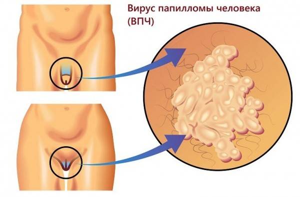 Папилломы при беременности: причины появления, лечение и последствия