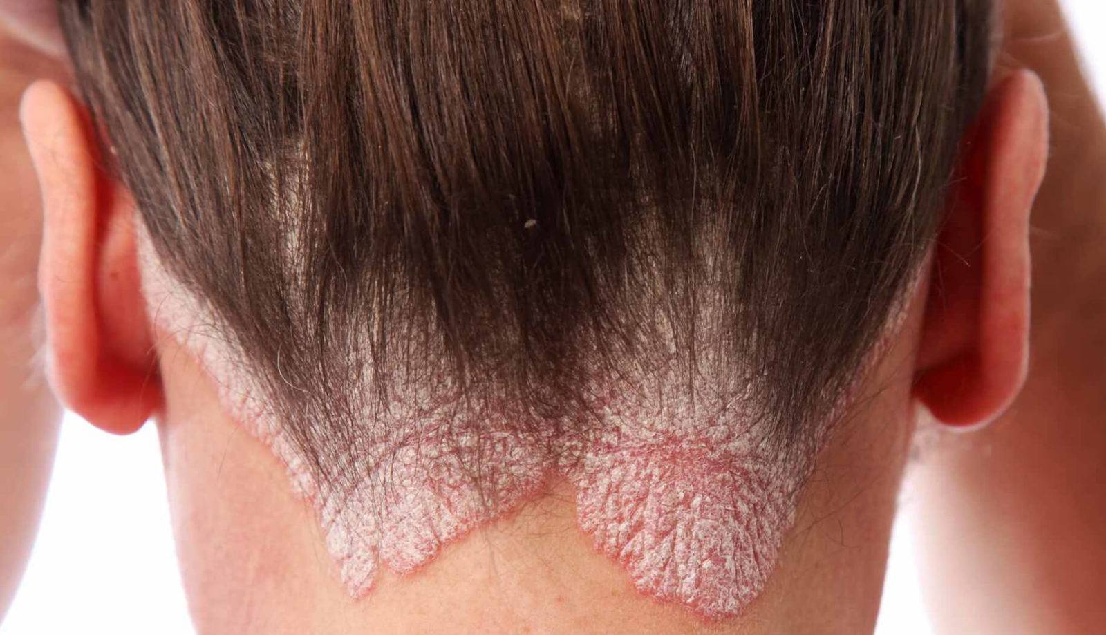Себорейный псориаз волосистой части головы, на лице: фото, симптомы, лечение народными средствами