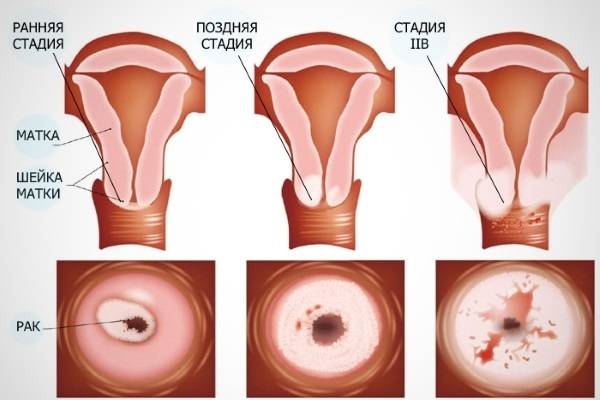 Папиллома шейки матки: симптомы папилломатоза у женщин