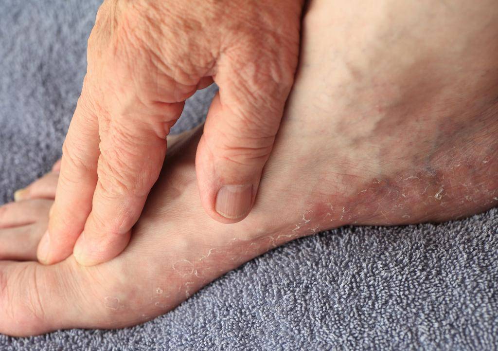 Псориаз на ногах: причины, симптомы, стадии, лечение, профилактика