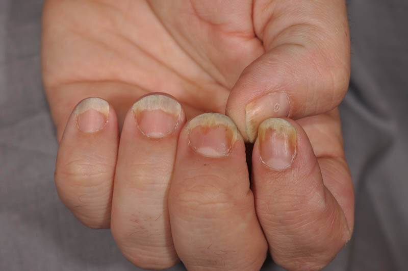 Псориаз ногтей, лечение и разновидности такого заболевания (фото)