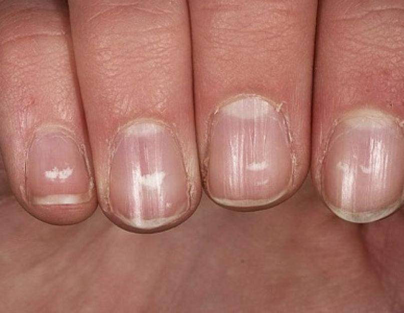 Продольные полосы на ногтях рук: причины и лечение, профилактические мероприятия, уход | mfarma.ru