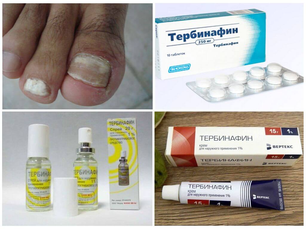 Тербинафин от грибка ногтей: инструкция, цена, отзывы и аналоги