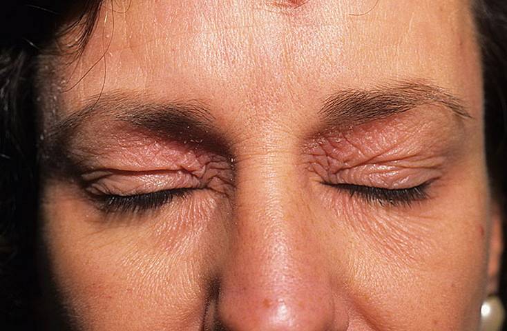 Псориаз на глазах, веках: симптомы с фото и лечение болезни
