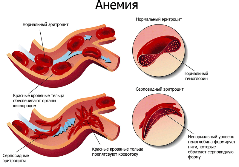 Схема анемии