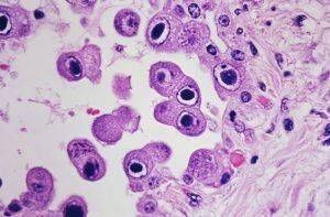 Цитомегаловирус под микроскопом