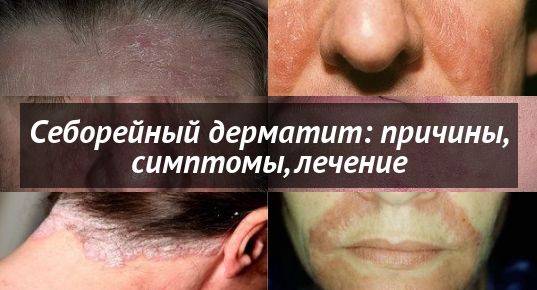Себорейный дерматит на лице: лечение, фото, профилактика