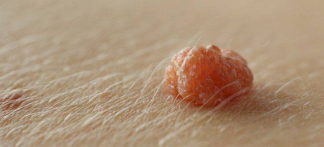 Плоскоклеточная папиллома кожи с гиперкератозом. симптомы, фото, лечение | vrednuga.ru