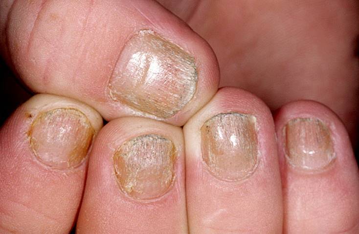 Псориаз ногтей — диагностика, причины появления, симптомы и их проявления. 140 фото болезни и видео лечения