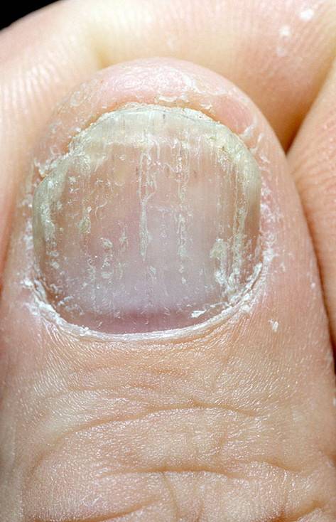 Псориаз ногтей: лечение в домашних условиях, фото болезни