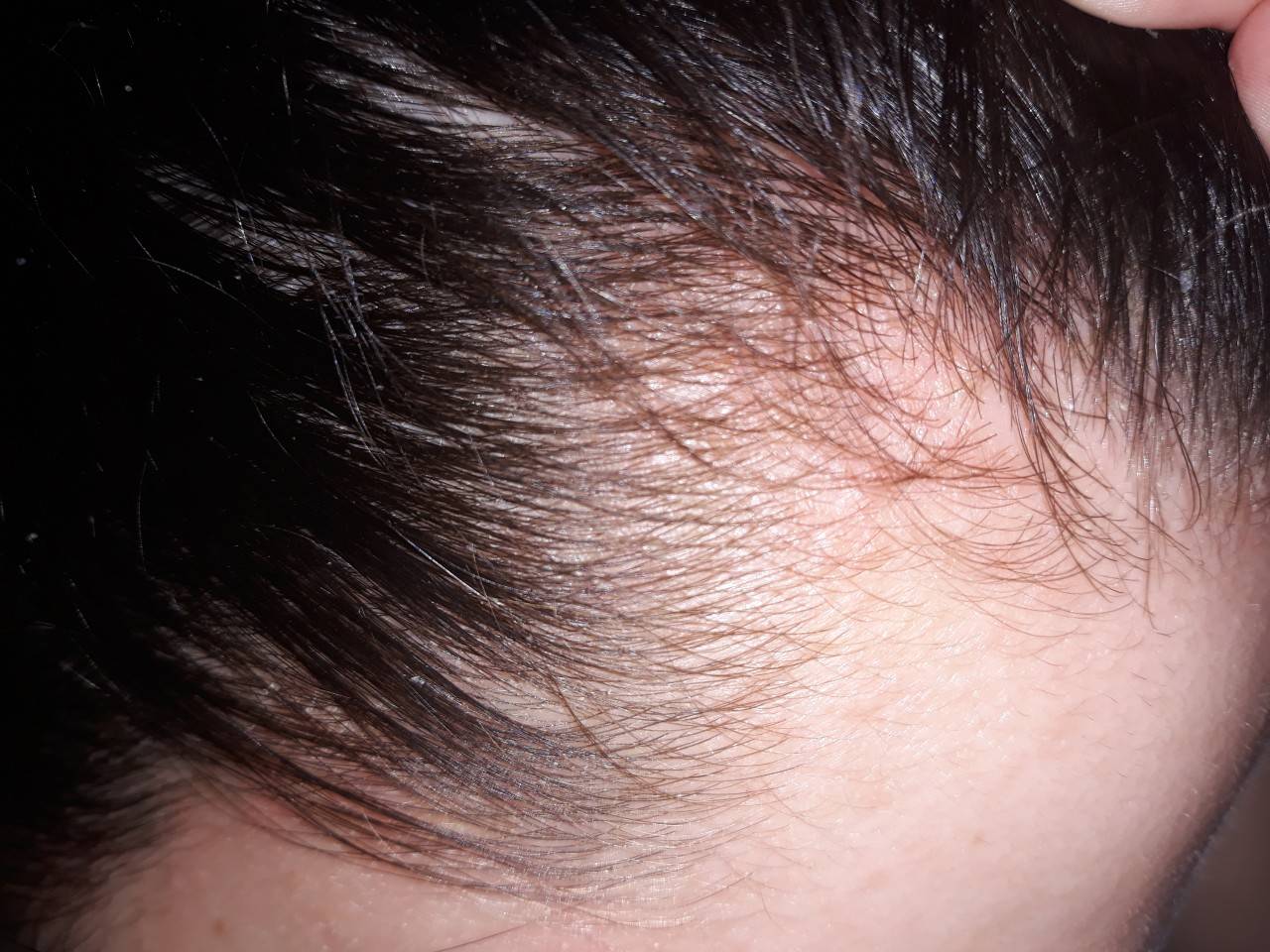 Псориаз на голове: как выглядит (фото), причины возникновения, как начинается, отличие от других болезней волосистой части головы