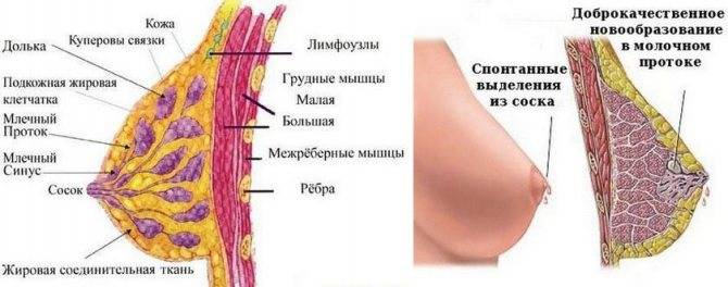 Папилломы под грудью у женщин: фото и как избавиться от них