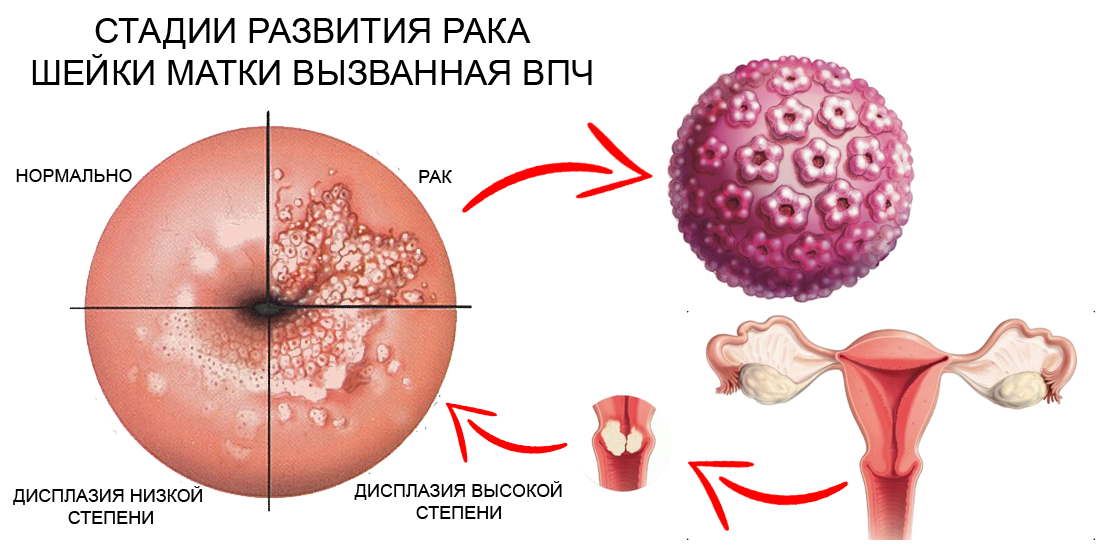 Как проявляется папиллома матки? как выглядит папилломатоз в полости матки? методы лечения болезни