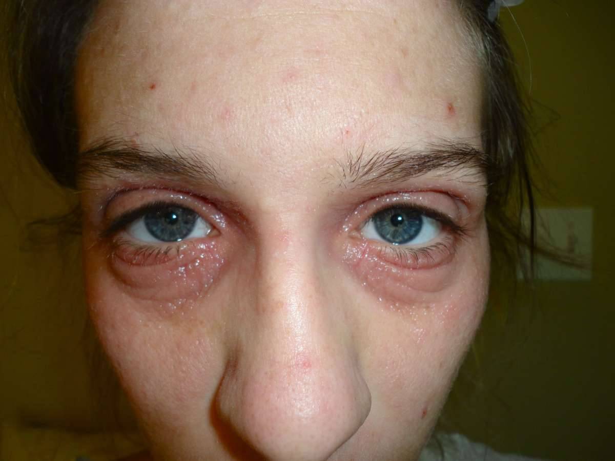 Причины, признаки и лечение псориаза на глазах