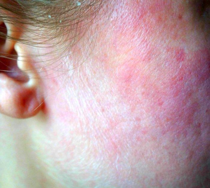 Псориаз кожи - описание болезни и стадии ее развития (110 фото)