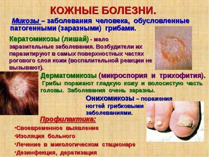 Микробная экзема, в том числе на ногах, лице: лечение, причины возникновения, профилактика, особенности острой и хронической форм