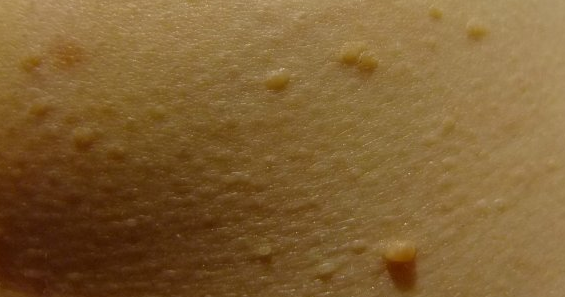 Папилломы под грудью: топ методов удаления без последствий — бородавки и папилломы