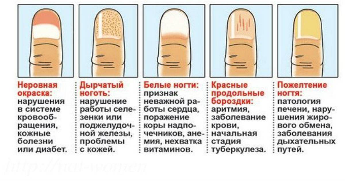 Белые полоски на ногтях: что означают, причины, лечение