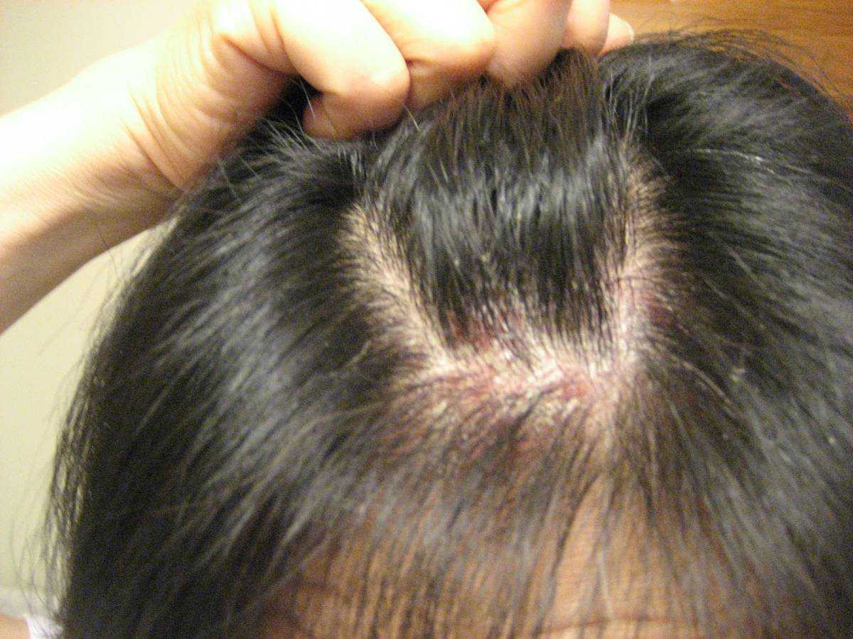 Псориаз волосистой части головы симптомы и  лечение