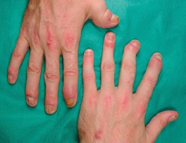 Псориатический артрит: симптомы, причины, лечение и профилактика