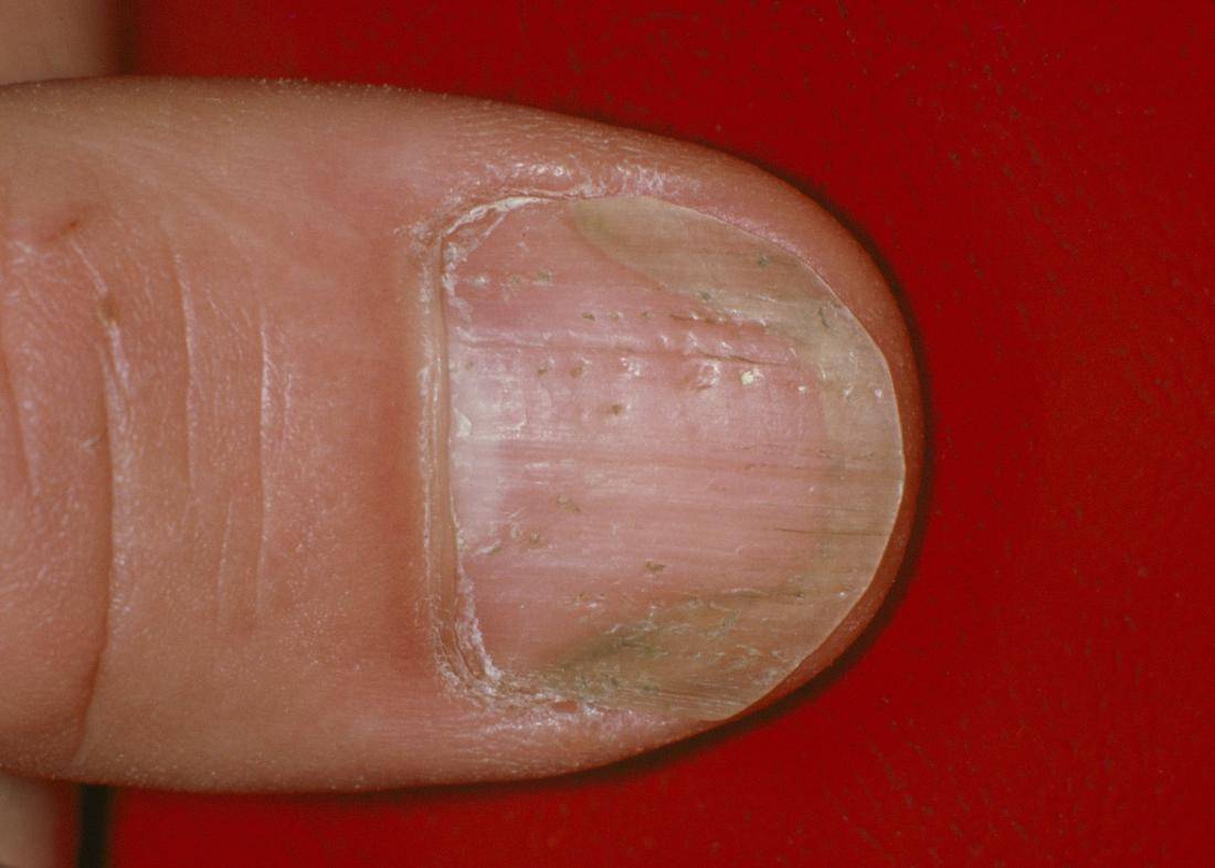 Псориаз ногтей на ногах - виды, симптомы и лечение