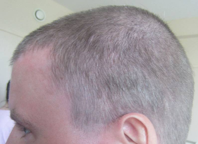 Как лечить псориаз на голове, фото начальной стадии волосистой части, симптомы и лечение в домашних условиях
