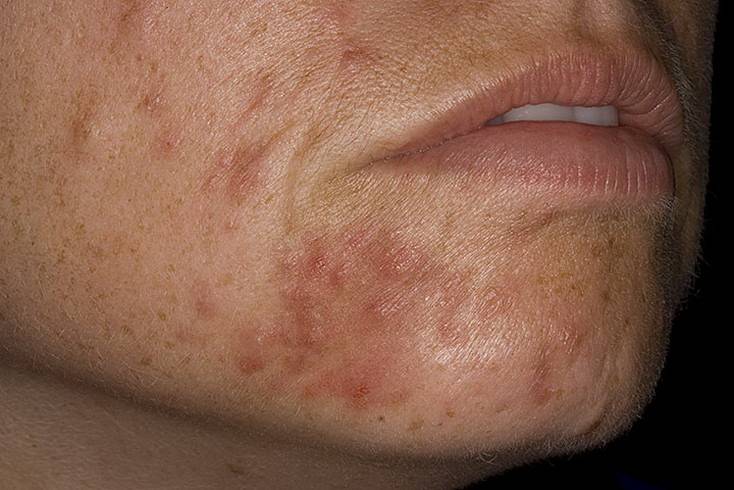 Периоральный (пероральный) дерматит на лице: причины и лечение мазями и другими препаратами, народные средства, фото