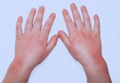 Солнечный дерматит — патология, требующая лечения