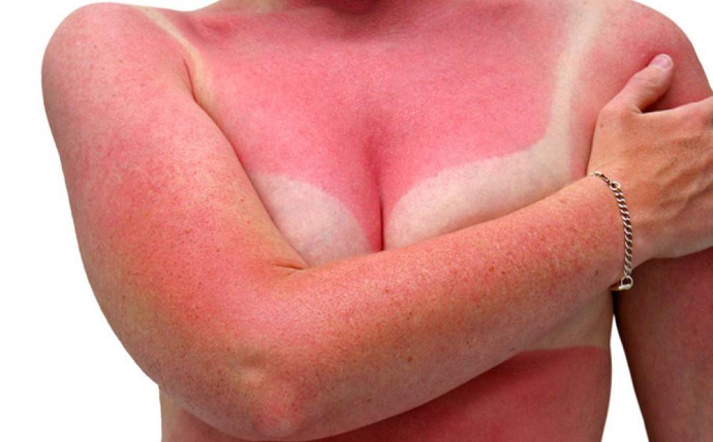 Солнечный дерматит, причины возникновения и как лечить