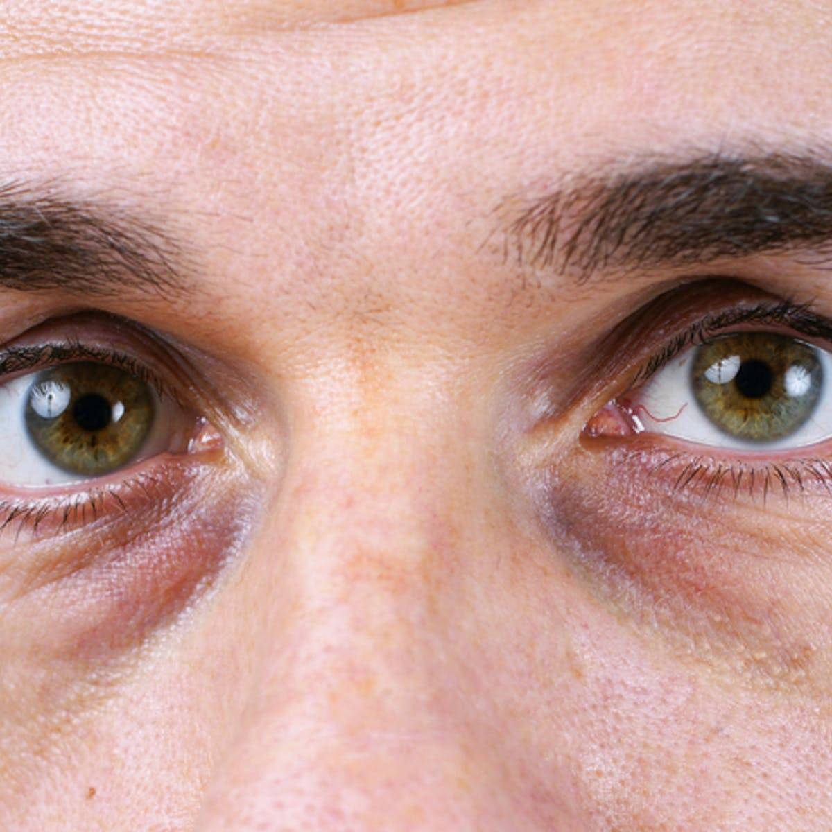 Круги под глазами – причины болезни у женщин, лечение
