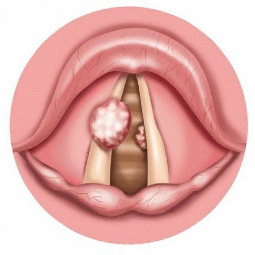 Папиллома в горле: удаление папилломы в гортани