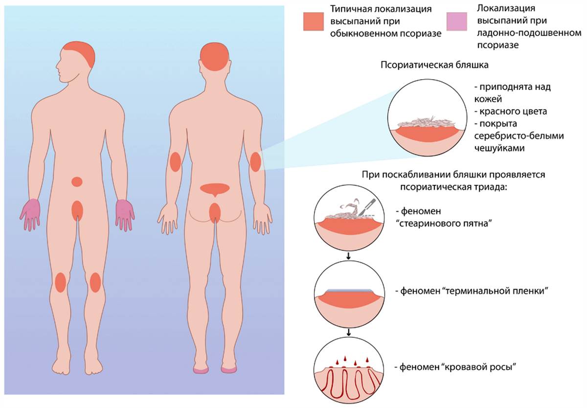 Псориаз на теле: стадии, диагностика и эффективные средства лечения (120 фото)
