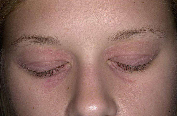 Псориаз на глазах: причины, симптомы и лечение. псориаз на веках и глазах: как лечить заболевание?