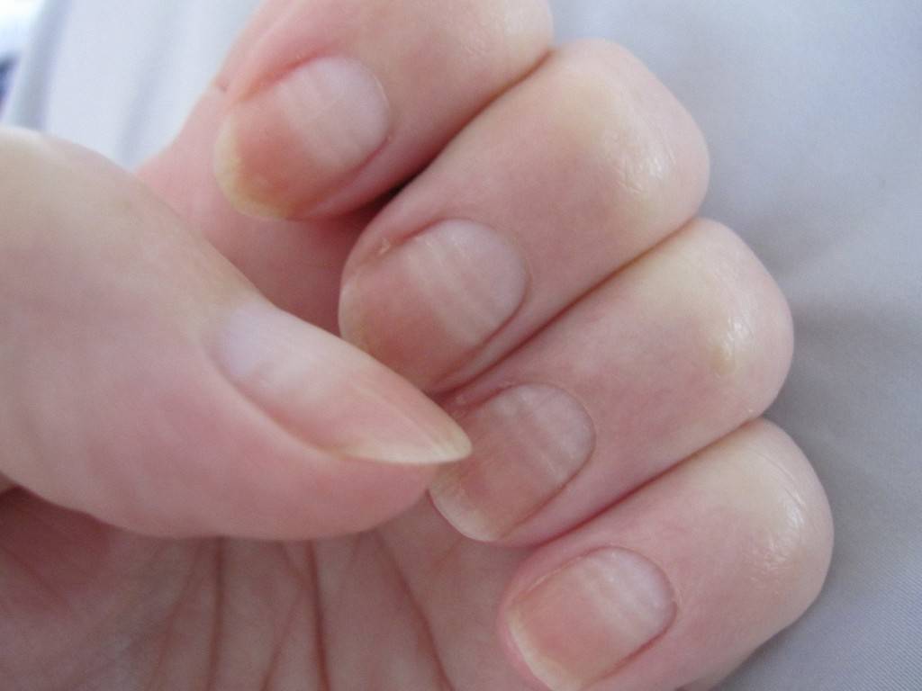 Полосы на ногтях - продольные или поперечные, причины появления, диагностика, методы лечения и профилактика