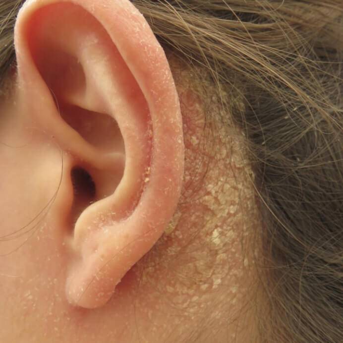 Перхоть в ушах: причины появления, как вылечить в домашних условиях