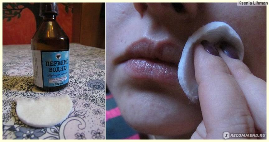 Как удалить усы – как избавиться от усиков у девушки навсегда в домашних условиях, безопасно, чтобы не росли, как убрать ниткой, перекисью, советы врачей — triksklad.ru — уютный трикотаж