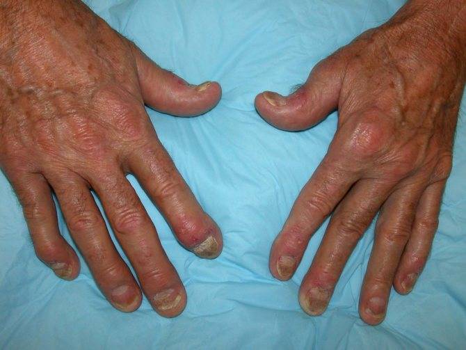 Псориатический артрит: симптомы и лечение, фото, причины болезни