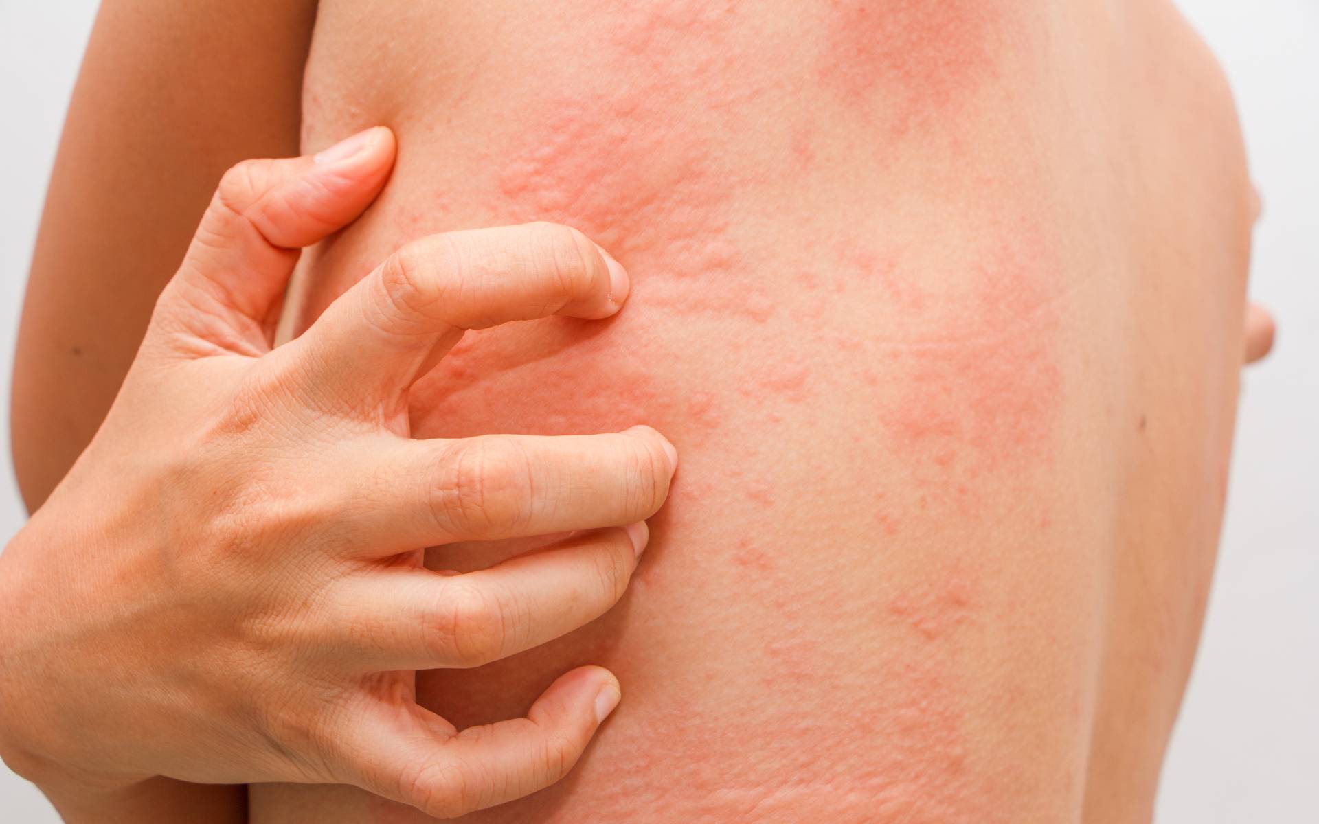 Причины, лечение и профилактика солнечного дерматита