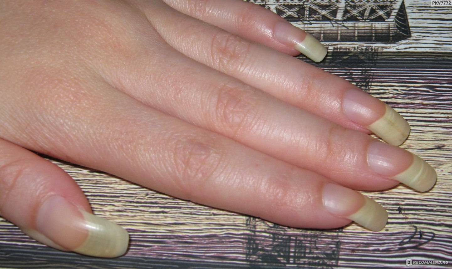Жёлтые ногти на руках: причины пожелтения у мужчин и женщин, лечение дома