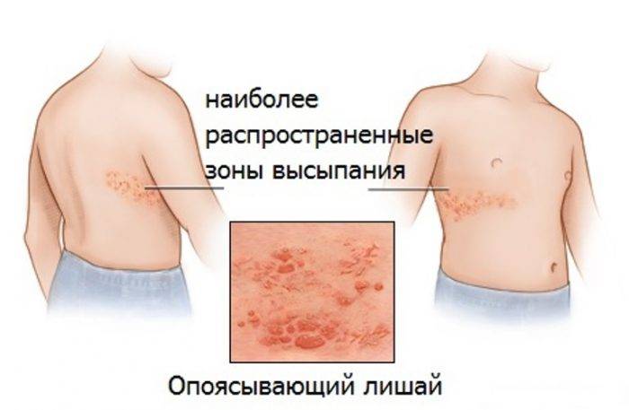 Опоясывающий лишай у детей: как выглядит на фото, причины и симптомы, через сколько пройдет, лечение | pro-herpes.ru
