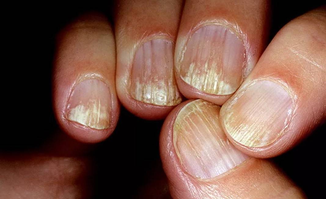 Полоски на ногтях, причины появления и методы лечения