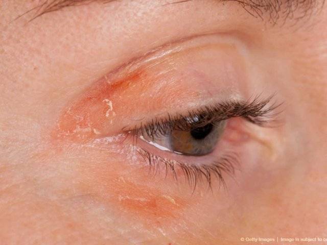 Псориаз на глазах: фото, симптомы и лечение