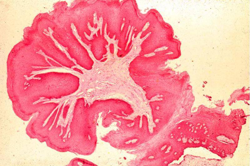 Плоскоклеточная папиллома: причины появления и симптомы вируса