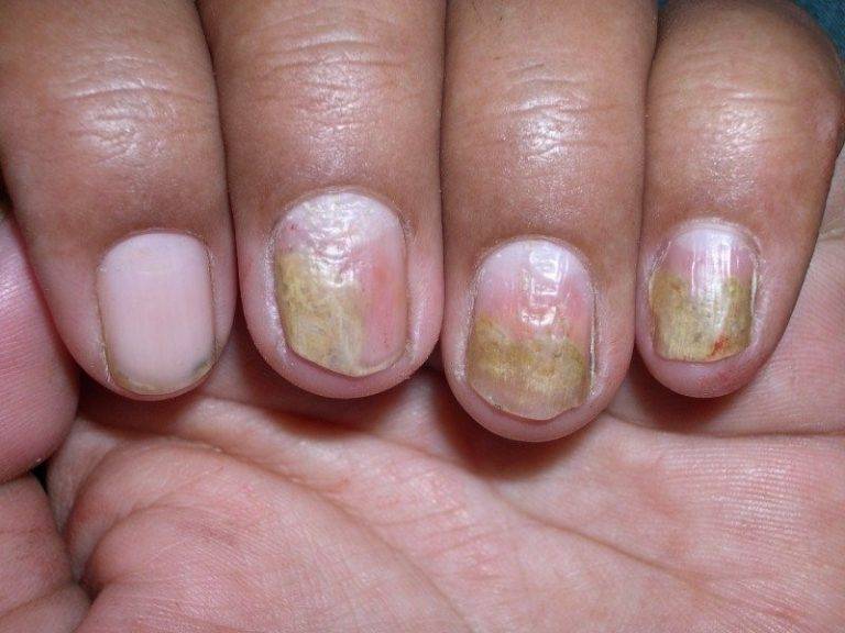 Псориаз ногтей: причины, признаки и лечение (фото + видео)