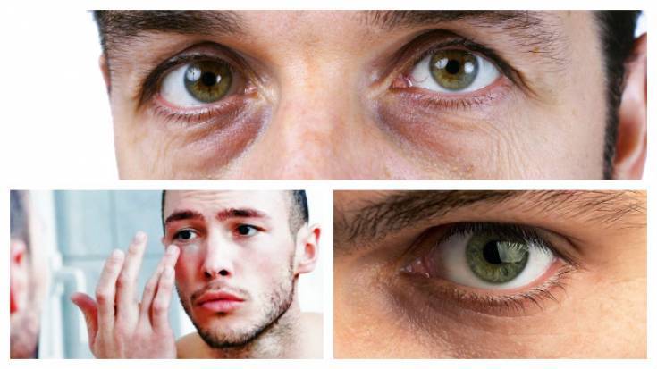 Тёмные круги под глазами у мужчин: причины, лечение oculistic.ru
тёмные круги под глазами у мужчин: причины, лечение