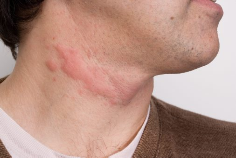 Пузырчатый дерматит - лечим аллергию