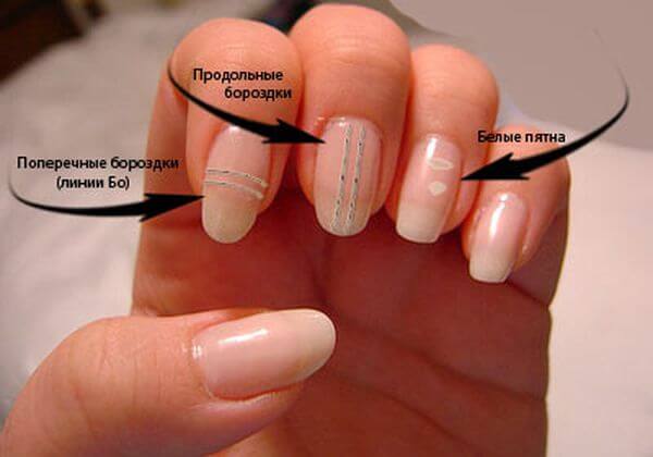 Белые полоски на ногтях – причины возникновения, варианты лечения
