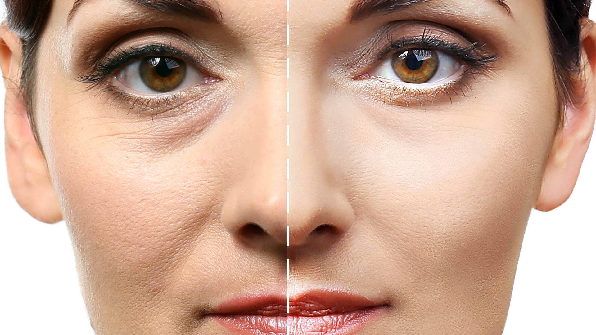 Как можно эффективно убрать морщины под глазами