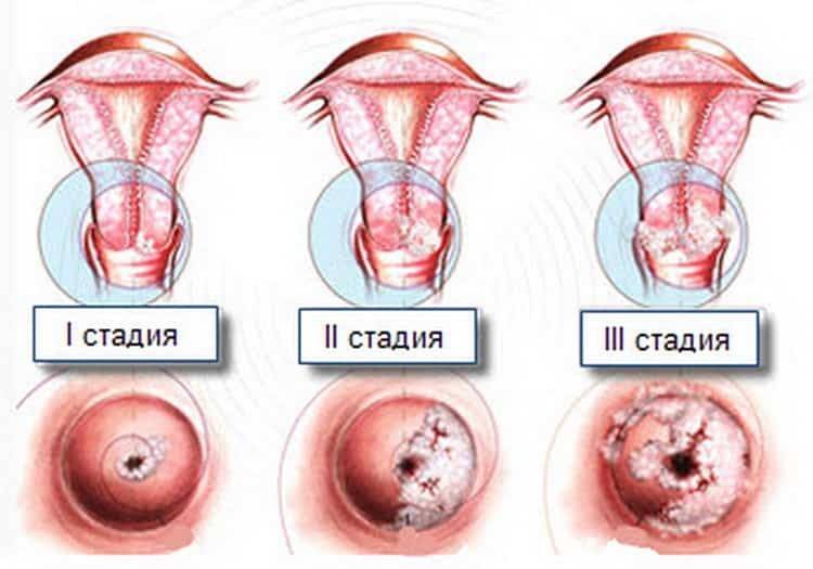 Папилломы шейки матки - виды, причины, симптомы, диагностика и лечение