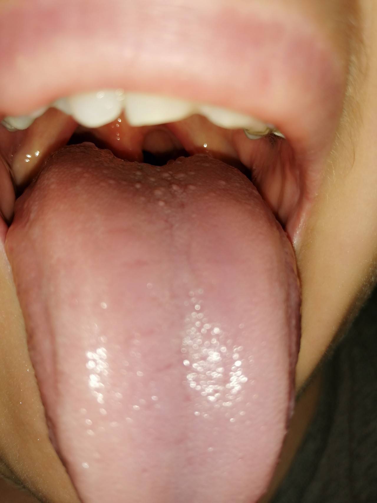 4 вида папиллом во рту (на языке, небё, десне) что это за болезнь
